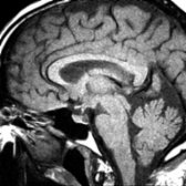 Sagittal T1 MR in a patient with a headache but no neurologic symptoms shows a small, hypointense cyst  that followed CSF on all sequences. It was an incidental finding and presumed to be a Rathke cleft cyst.