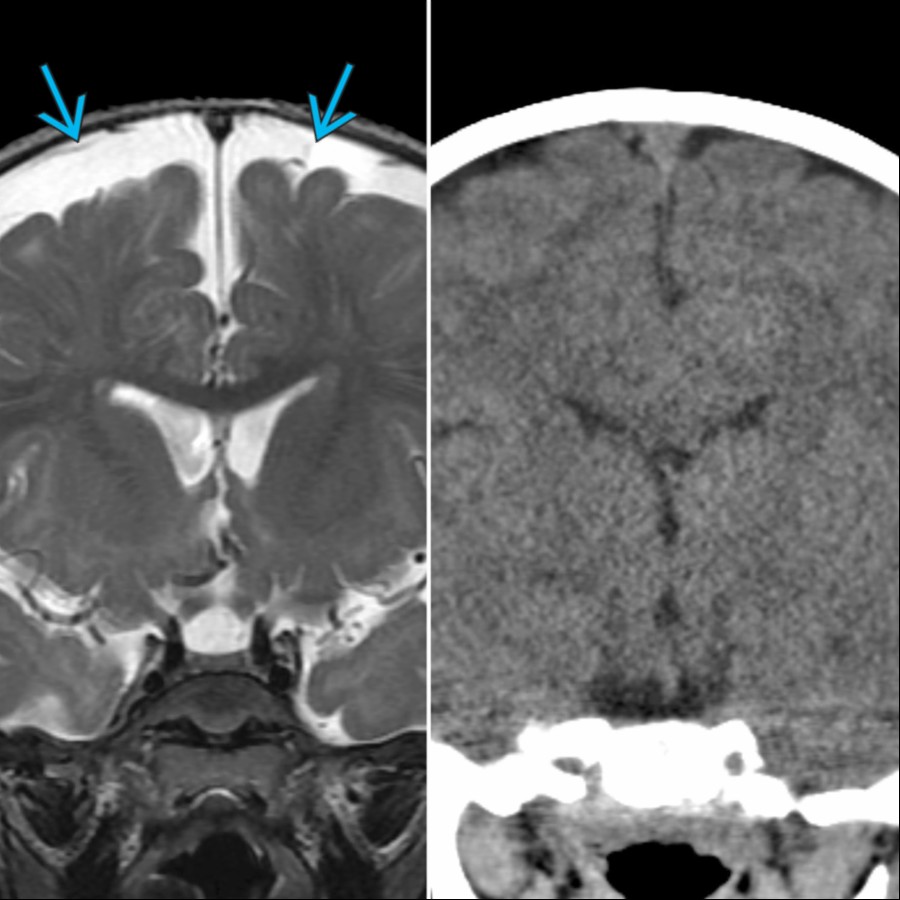 Coronal T2 MR at 13 months (left) & NECT at 5 years (right) of age show expected resolution of the enlarged SAS  over a 4-year period. Enlarged SAS typically resolve by 24 months of age.