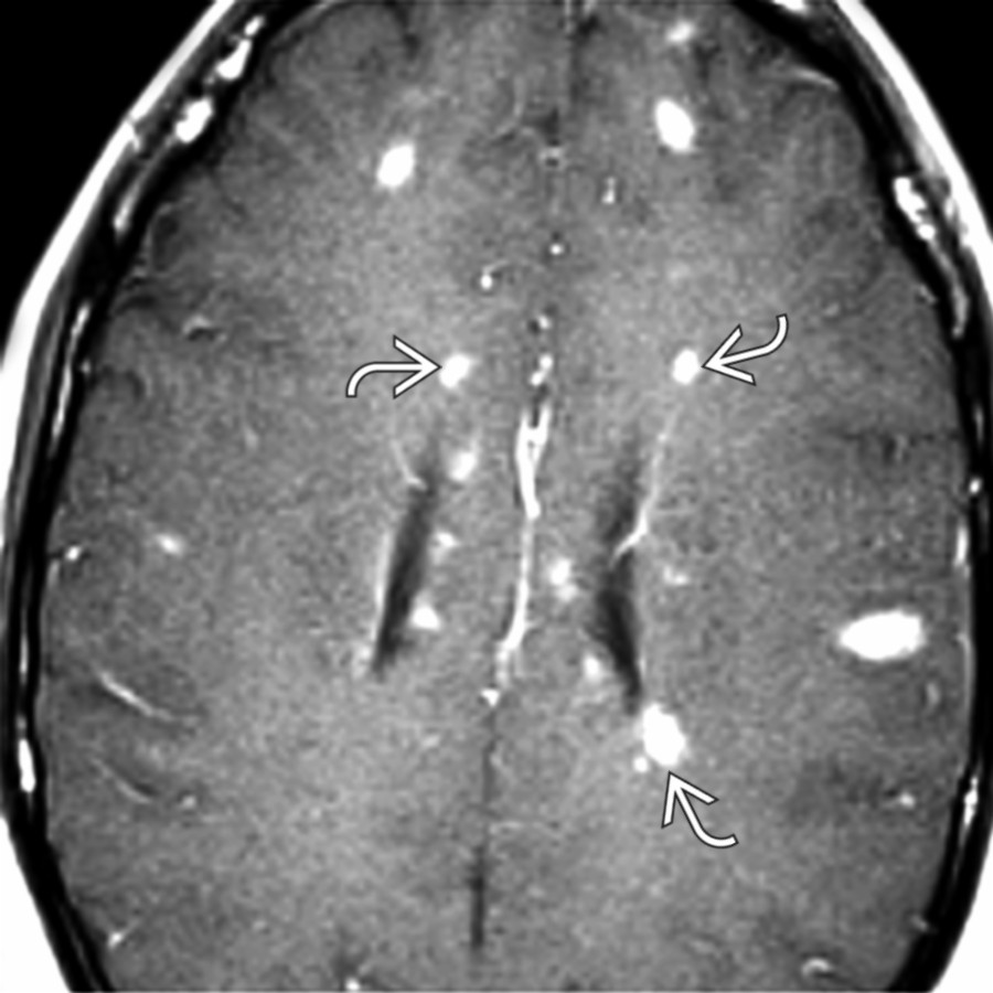 Axial T1 C+ MR shows numerous enhancing MS plaques in the periventricular  and subcortical WM. Note the typical lack of mass effect. ADEM and Lyme disease may be identical.