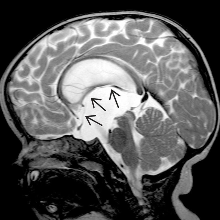 A large suprasellar arachnoid cyst balloons upward  and obstructs the foramina of Monro in this 1-year-old with macrocrania.