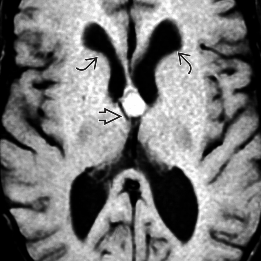 Axial T1 MR shows a well-defined, hyperintense lesion  at the foramen of Monro in a patient with headaches, most consistent with a colloid cyst. Note the enlargement of the lateral ventricles  due to obstruction at the foramen of Monro.