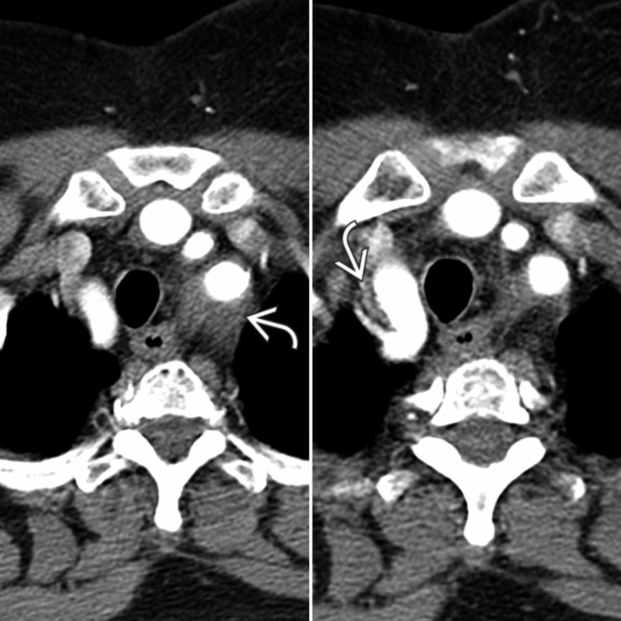 Axial CTA of the chest in a patient with giant cell arteritis (GCA) shows soft tissue  density material surrounding the great vessels. (Courtesy C. S. Restrepo, MD.)