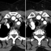 Axial CTA of the chest in a patient with giant cell arteritis (GCA) shows soft tissue  density material surrounding the great vessels. (Courtesy C. S. Restrepo, MD.)
