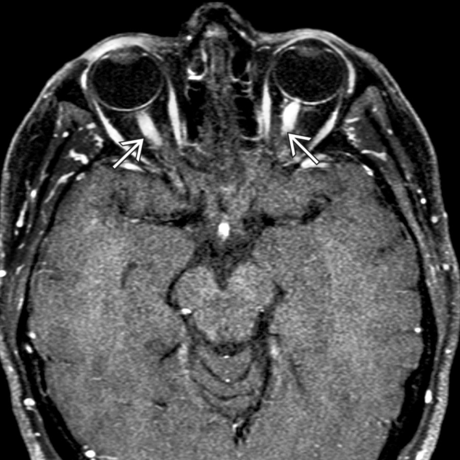 Axial T1 C+ FS MR shows bright enhancement of the optic nerves  similar to the extraocular muscles in a patient with MS with acute bilateral optic neuritis.