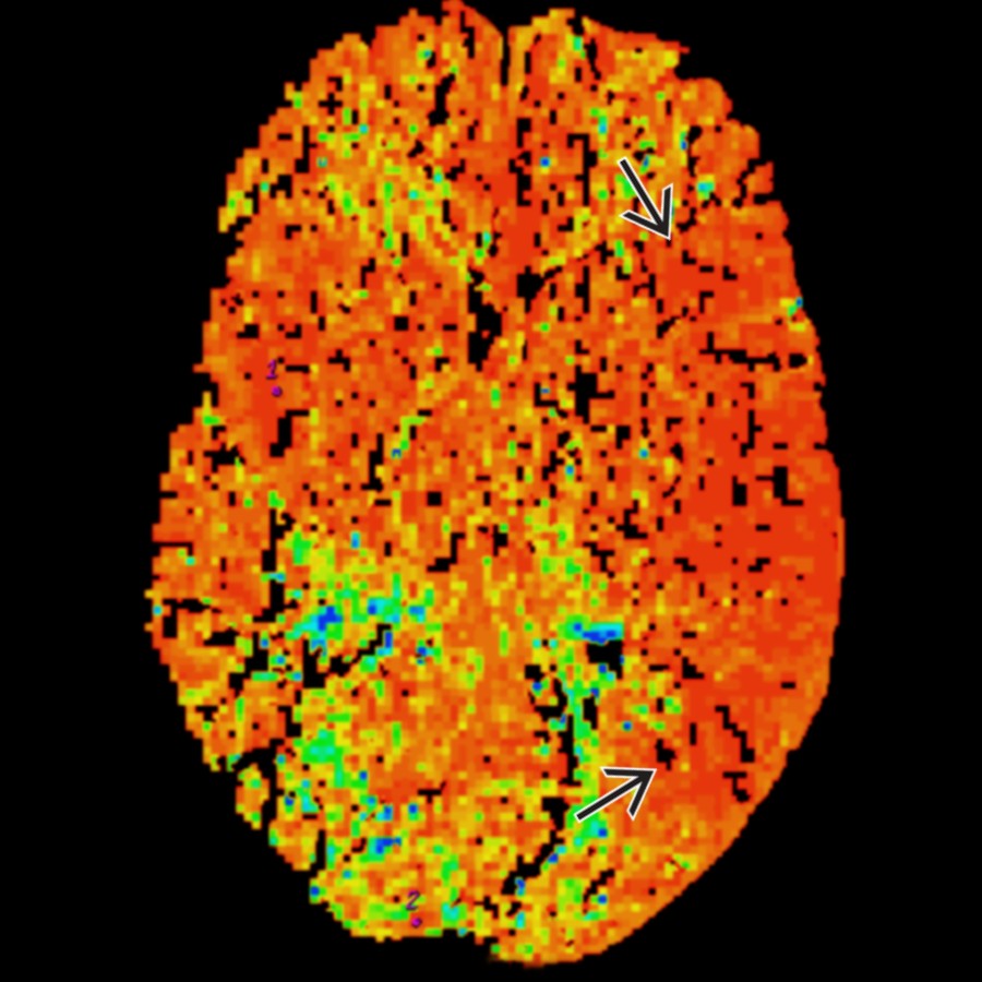 Axial MR perfusion in the same patient shows elevated cerebral blood volume .