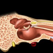 Sagittal graphic shows the medial wall of the middle ear. Note craniocaudal orientation of the lateral semicircular canal (LSCC), facial nerve (tympanic segment), oval window (stapes footplate attaches to oval window), and cochlear promontory (bony bulge covering the basal turn of cochlea). Greater superficial petrosal nerve (GSPN) originates at geniculate ganglion in the anterior genu of the facial nerve, where the nervus intermedius of Wrisberg [(NIW) not shown] joins the facial nerve. Posteroinferiorly, the descending mastoid segment of the facial nerve exits the temporal bone at the stylomastoid foramen on its way to the parotid gland.
