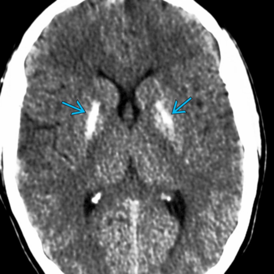 Axial NECT in a patient with congenital HIV shows bilateral symmetrical BG Ca⁺⁺ predominantly in the GP  . This Ca⁺⁺ is seen typically months after birth. With HIV, involvement of the lentiform nuclei Ca⁺⁺ is greater than the caudate heads.