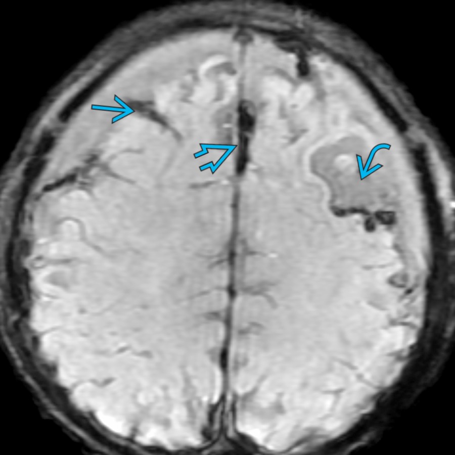 Axial SWI in a 6-week-old shows subdural  & subarachnoid  hemorrhage as well as an evolving left frontal lobe laceration  with hemorrhage level, a constellation of findings very suspicious of AHT.