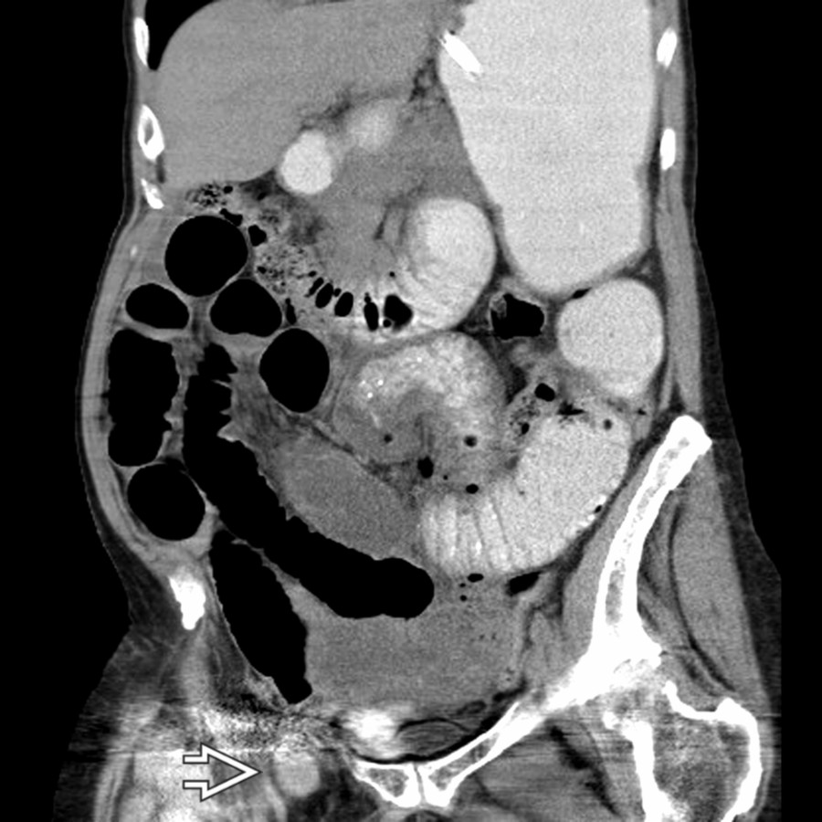 Coronal CECT shows a knuckle of small bowel  that is incarcerated within a femoral hernia, resulting in small bowel obstruction.