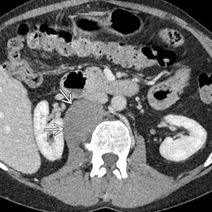 Axial CECT demonstrates a homogeneous mass  in the right psoas muscle that was incidentally discovered on imaging done for other reasons. This was shown to be a desmoid tumor on biopsy.