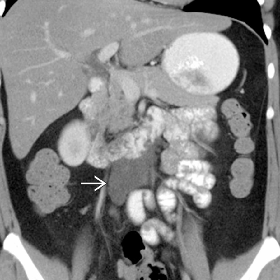 Coronal CECT demonstrates a retroperitoneal lymphangioma    abutting the duodenal sweep.  This lesion had been stable over many exams and was deemed to be benign.