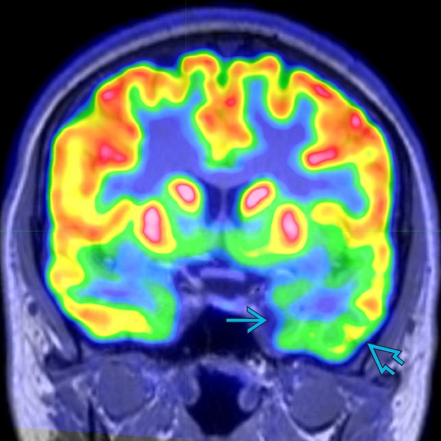 Coronal fused F-18 FDG PET/MR shows a region of interictal hypometabolism in the left parahippocampal gyrus , extending beyond the lesion . It is critical for F-18 FDG PET to identify the extent of seizure focus and adjacent functional deficit zone for planning of seizure-free surgical outcomes.