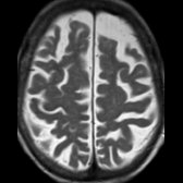 Axial T2WI MR in a patient with DLB shows nonspecific diffuse cortical atrophy. Conventional MR findings are frequently nonspecific in DLB.