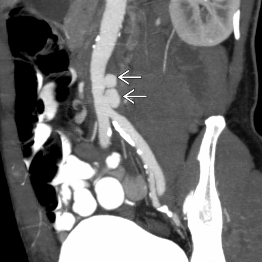 Oblique CTA reconstruction in the same patient shows 2 focal contrast outpouchings consistent with mycotic pseudoaneurysms  affecting the lateral wall of the abdominal aorta.