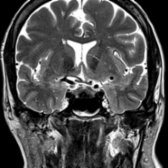 Coronal T2 MR in the same patient shows the mass is hypointense  and enlarges the pituitary gland. There is no compression of the optic chiasm . No enhancement of the lesion was present on postcontrast imaging (not shown). Rathke cleft cyst was confirmed at resection.