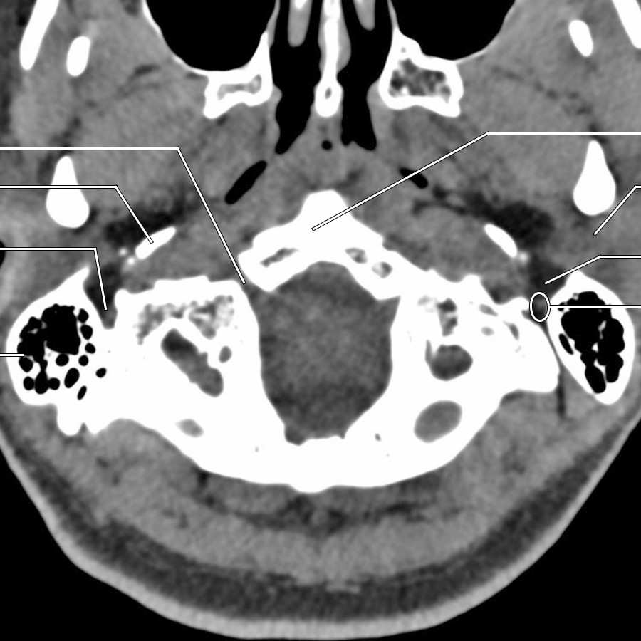 Axial soft tissue window NECT through the skull base demonstrates bilateral fat-containing stylomastoid foramen. CNVII exits from bone canal into the parotid space through this foramen.
