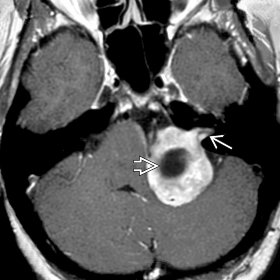 Axial T1 C+ MR shows a large enhancing vestibular schwannoma projecting from the internal auditory canal (IAC)   into the CPA cistern. The tumor has a large intramural cyst  that compresses the brainstem and cerebellum.