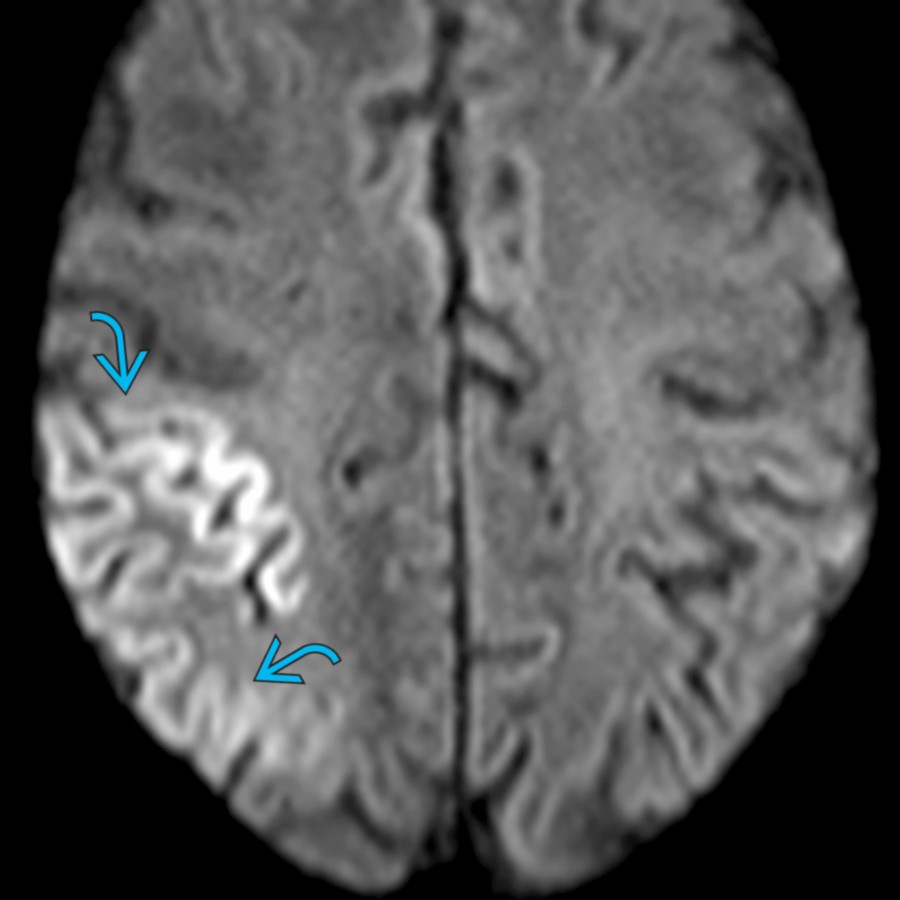 Axial DWI on day 1 in a patient presenting with status epilepticus (SE) demonstrates gyriform restricted diffusion .