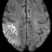 Axial DWI on day 1 in a patient presenting with status epilepticus (SE) demonstrates gyriform restricted diffusion .