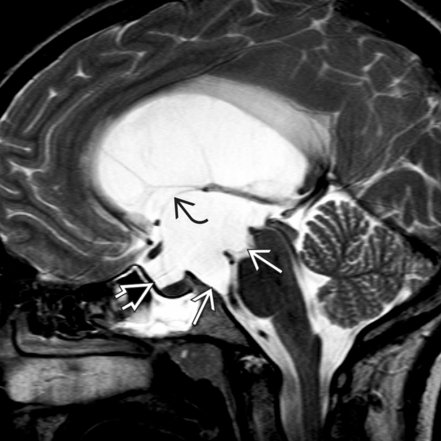 Sagittal T2WI FS MR shows a lobulated, sharply marginated, CSF-like, suprasellar cyst  extending into the sella , elevating the 3rd ventricle , and causing obstructive hydrocephalus.