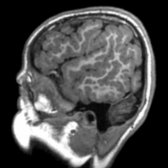 Parasagittal T1 MR in a 7-year-old boy with polymicrogyria shows irregularity & nodularity of the cortical surface & gray matter(GM)-white matter (WM) junction, typical of polymicrogyria.