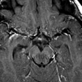Axial T1WI C+ MR confirms the ectopic position of the bright posterior pituitary gland  at the median eminence in the expected location of the infundibular stalk base.