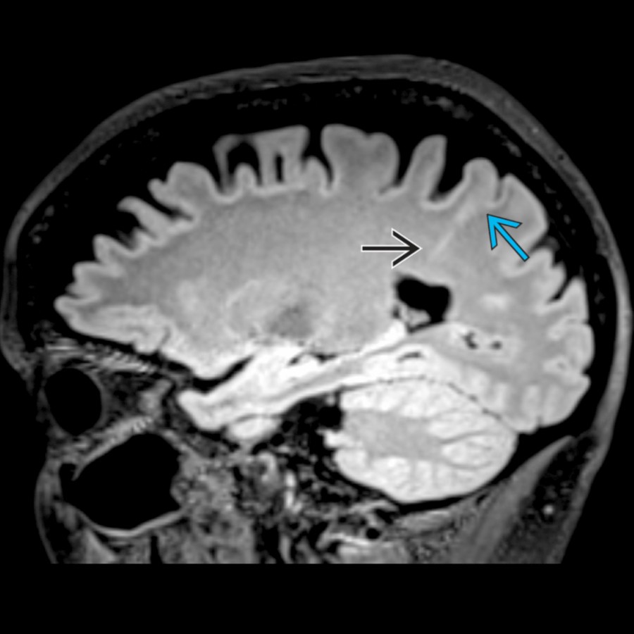 Sagittal FLAIR MR also shows a focal area of gray-white interface obscuration  with mild signal hyperintensity in the left postcentral gyrus and a subjacent linear hyperintensity  extending to the ventricular margin, consistent with small focal cortical dysplasia (FCD).