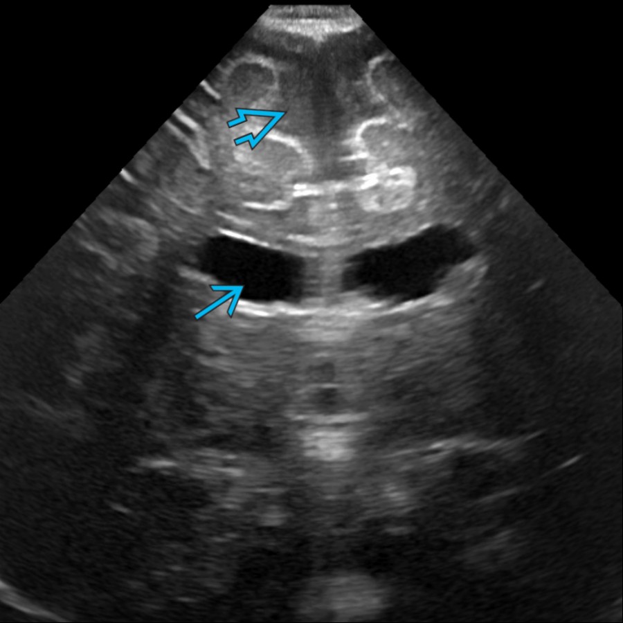 Coronal US in a 3 month old with macrocephaly shows prominent SAS  as well as mild enlargement of the lateral ventricles . Mild lateral ventricular enlargement is common in benign enlargement of subarachnoid spaces (BESSI).