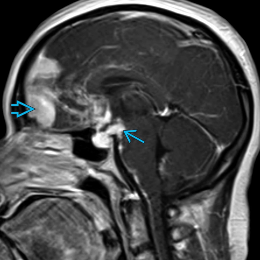 Sagittal T1 C+ MR shows intense enhancement in the suprasellar cistern, particularly with thickening of the stalk . Furthermore, there is abnormal enhancement involving the pial surface and parenchyma of the frontal lobes  in this patient with neurosarcoidosis.