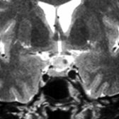 Coronal T2 MR shows that most of the suprasellar mass is isointense with gray matter. Note the focal, hypointense nodule , virtually pathognomonic of a Rathke cleft cyst.