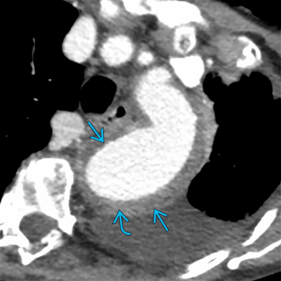 Axial CECT of a patient with sepsis and chest pain shows aneurysmal dilation of the proximal descending thoracic aorta  with associated diffuse aortic wall thickening and enhancement , consistent with infectious aortitis.