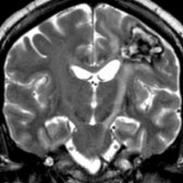 Coronal T2WI shows a cavernous malformation in left precentral gyrus . T2 hyperintensity along the course of cortical spinal tract (CST)  indicating antegrade wallerian degeneration (WaD).