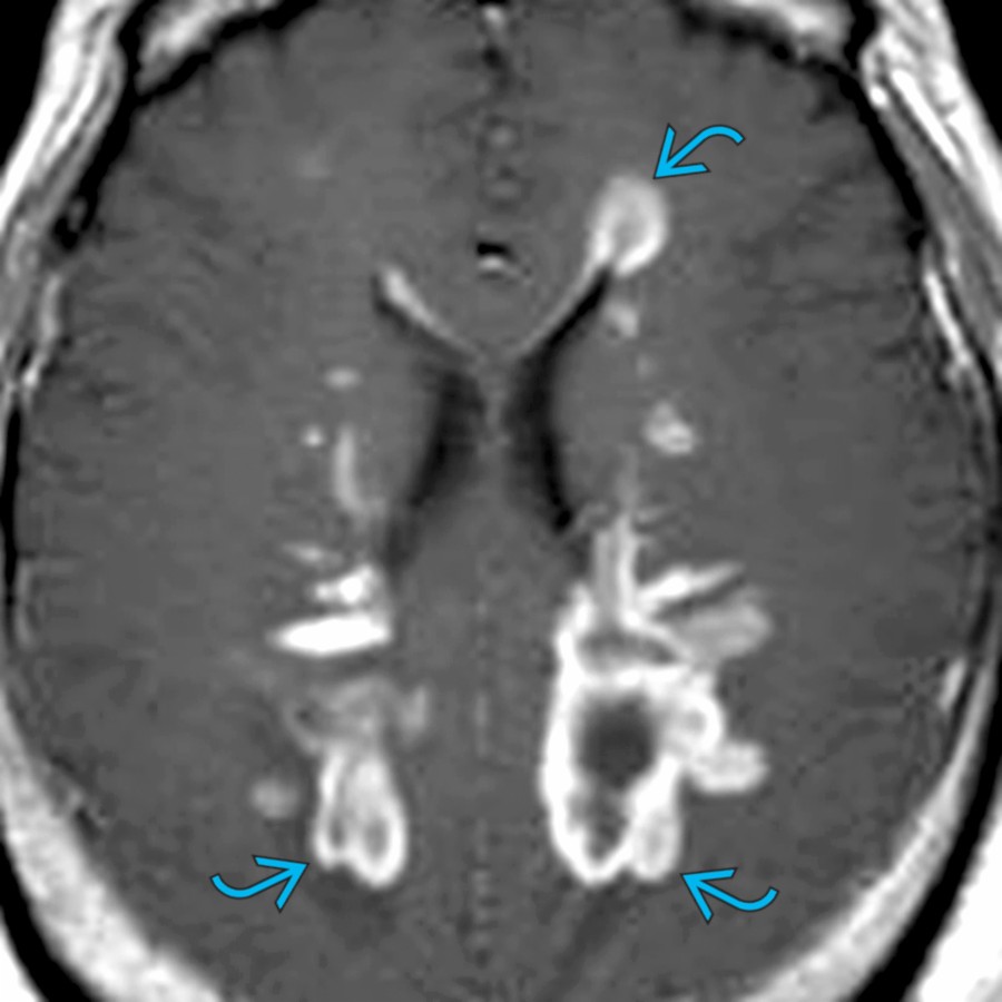 Axial T1 C+ MR shows bilateral multiple periventricular enhancing demyelinating lesions  in a patient with ADEM. ADEM typically follows an infection or vaccination  and can involve gray matter.