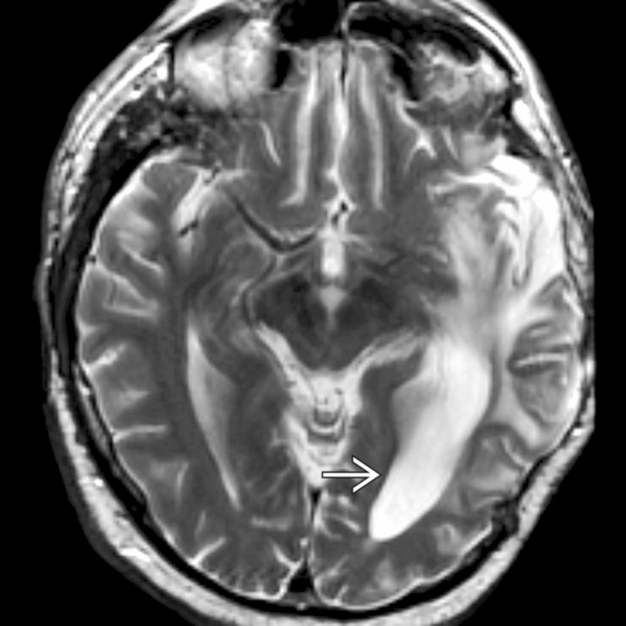 Axial T2 MR shows irregular enlargement of the left occipital horn  due to left temporal and occipital surgical defect and encephalomalacia from tumor removal in this location.