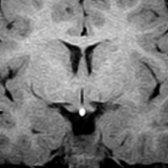 Coronal T1 MR depicts the ectopic posterior pituitary gland location at the median eminence  of the hypothalamus. A pituitary stalk is not visualized below the ectopic posterior pituitary. The septum pellucidum is present, and the optic tracts  are of normal size.
