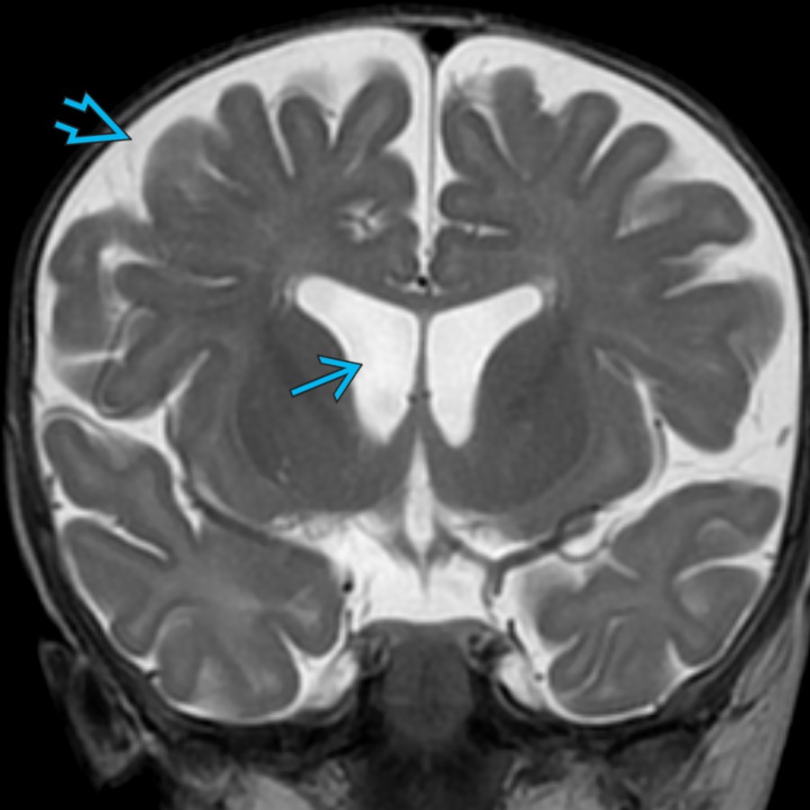 Coronal T2 MR in a 6 month old with macrocephaly shows symmetrically prominent bifrontal SAS  with mild enlargement of the lateral ventricles . Mild enlargement of the lateral ventricles should not dissuade one from suggesting BESSI.