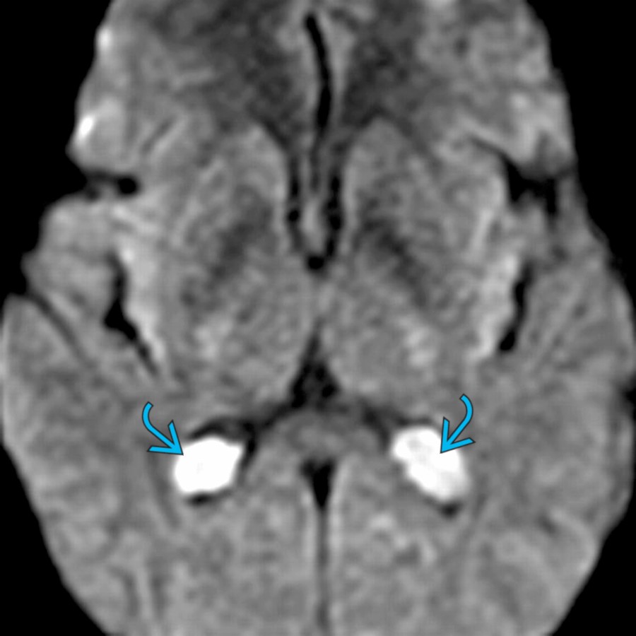 Axial DWI MR shows characteristic large choroid plexus cysts  in the atria of both lateral ventricles within the choroid plexus glomi. Choroid plexus cysts, often called choroid plexus xanthogranuloma, are nonneoplastic noninflammatory cysts. Between 60-80% appear quite bright on DWI, as in this case.