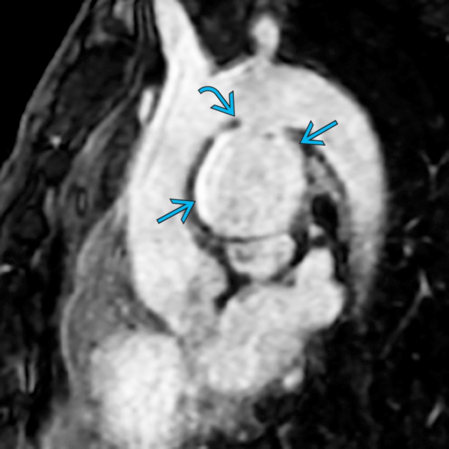 Double oblique MRA of the thoracic aorta in a patient with a history of thoracic trauma shows a saccular aneurysm  of the aortic arch. Acute angles of the aneurysm  differentiate this pseudoaneurysm from a ductus diverticulum.