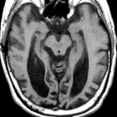 Axial T1WI MR through the inferior temporal lobes shows marked atrophy of the temporal lobes and enlargement of the lateral ventricles.