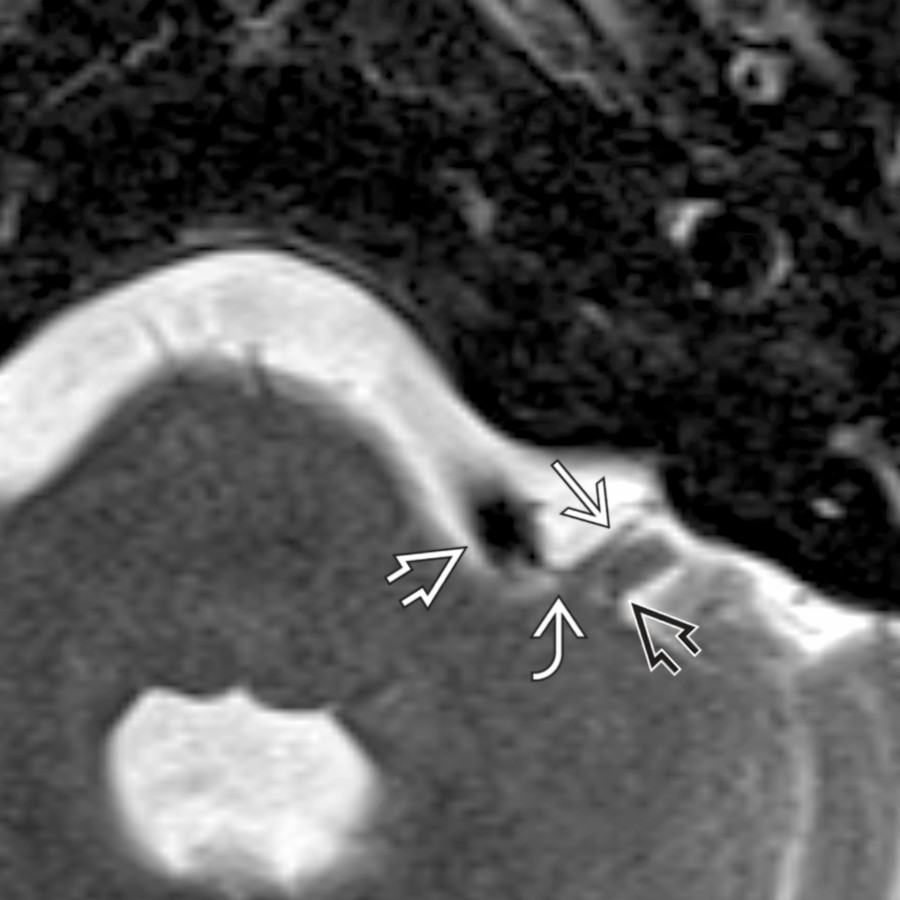 Axial T2 FS MR in a patient with left hemifacial spasm (HFS) shows neurovascular compression of the left facial nerve  by an ectatic vertebral artery . Note the point of neurovascular impingement  against the adjacent cerebellar flocculus .