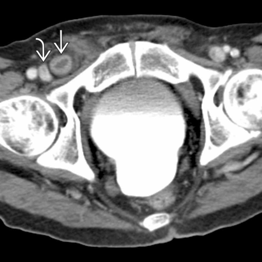Axial CECT shows the characteristic position of a femoral hernia with a knuckle of bowel  identified medial to the femoral vessels. Note the characteristic compression of the adjacent femoral vein .