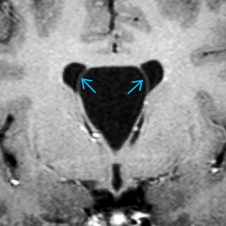 Coronal T1 C+ MR in the same patient shows the large CSP bowing the leaves of the septum pellucidum laterally .