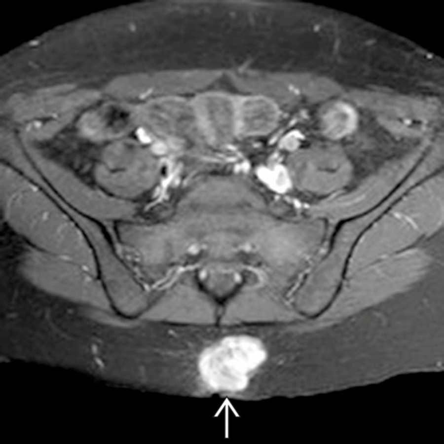 Axial T1 C+ FS MR in the same patient demonstrates that the mass exhibits substantial enhancement with mildly irregular margins . This was found to be a desmoid tumor at resection.