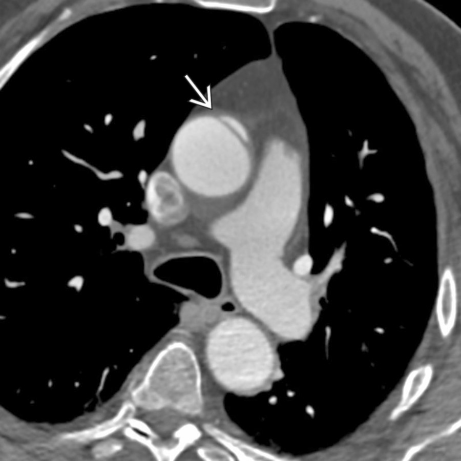 Chronic LITs show slightly thicker ,  undermined edges, no periaortic stranding,  and no associated intramural blood.