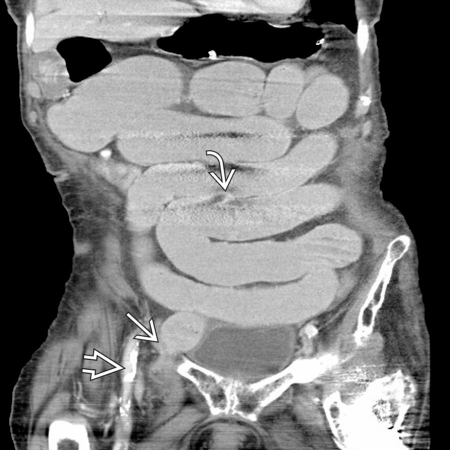 Coronal CECT in the same patient demonstrates multiple dilated loops of small bowel  with abrupt narrowing at the level of a segment of bowel  coursing into the femoral ring, medial to the femoral vessels , compatible with small bowel obstruction secondary to a femoral hernia.