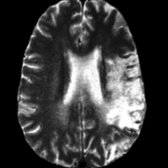 Axial T2WI MR shows a large left middle cerebral artery infarct, which resulted in ipsilateral WaD (not shown).