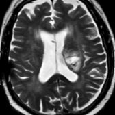 Axial T2WI MR shows a heterogeneous hyperintense lesion involving the left corona radiata and CST   related to a glioblastoma. Note the internal curvilinear T2 hypointensity related to blood products or proteinaceous debris.