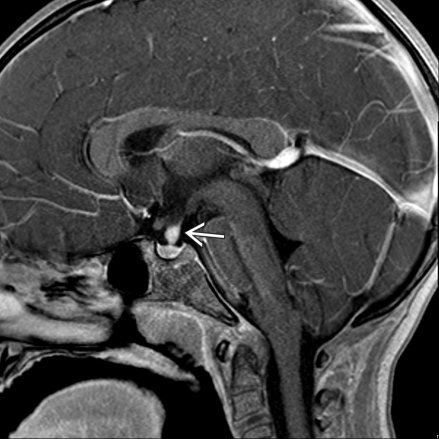 Sagittal T1 C+ FS MR shows a thickened, enhancing pituitary stalk  in a child with Langerhans cell histiocytosis (LCH). There is typically a lack of the posterior pituitary "bright spot." Pay attention for additional enhancing lytic calvarial lesions with a beveled edge appearance classic for LCH.