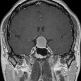 Coronal T1 C+ MR shows a sellar and suprasellar Rathke cleft cyst with a classic claw sign of compressed pituitary gland  surrounding the nonenhancing mass.  Note the superior displacement of the optic chiasm as it is draped over the mass  .