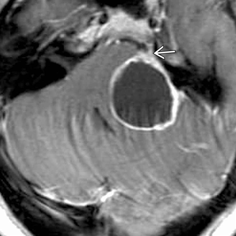 Axial T1 C+ MR in a patient presenting with left facial pain demonstrates a peripherally enhancing cystic mass in the left CPA with a vector of spread extending towards Meckel cave , that was the clue to its origin.